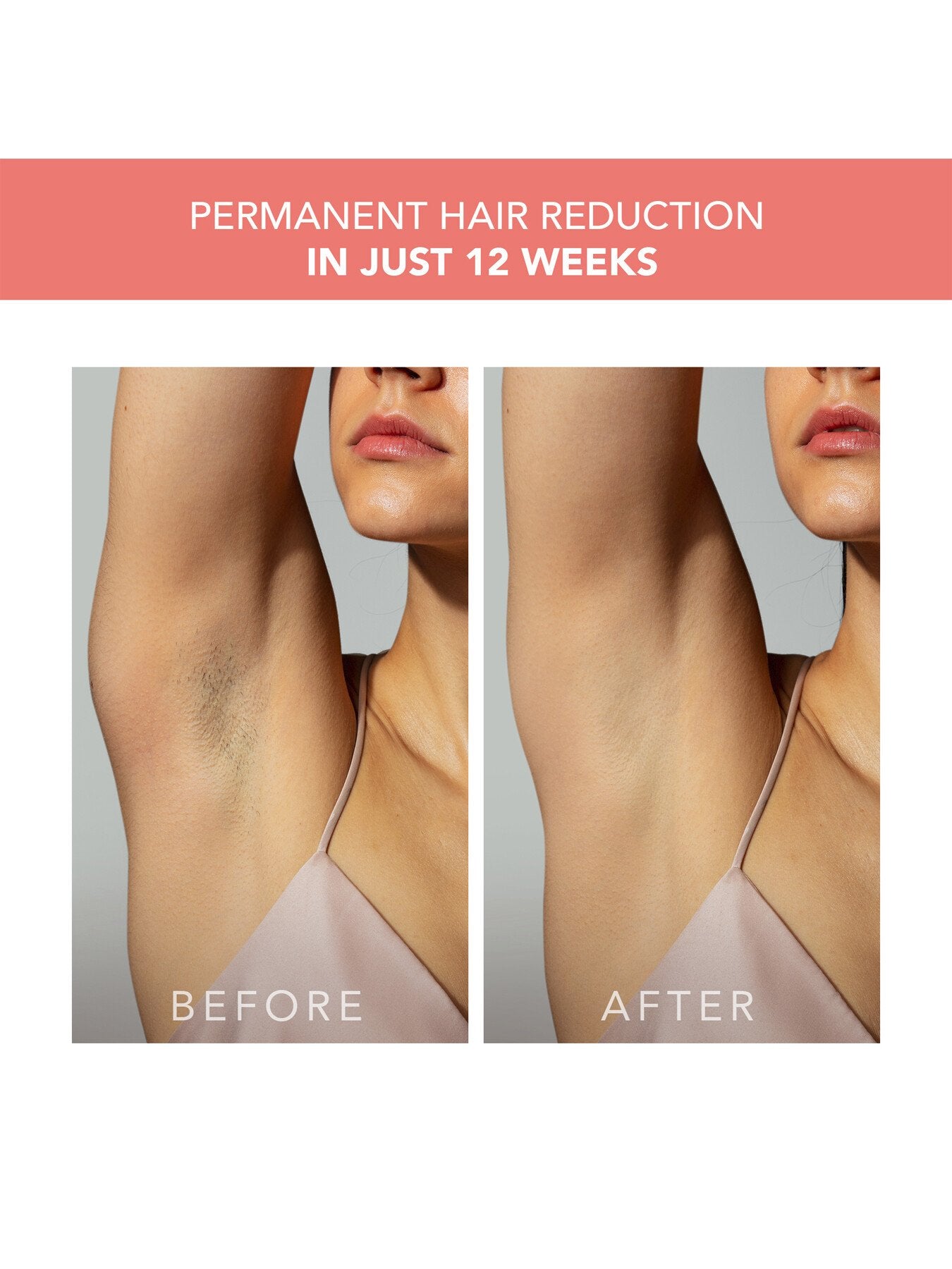 PEACH™ 2 - Advanced IPL Hair Removal Device with Skin Cooling System