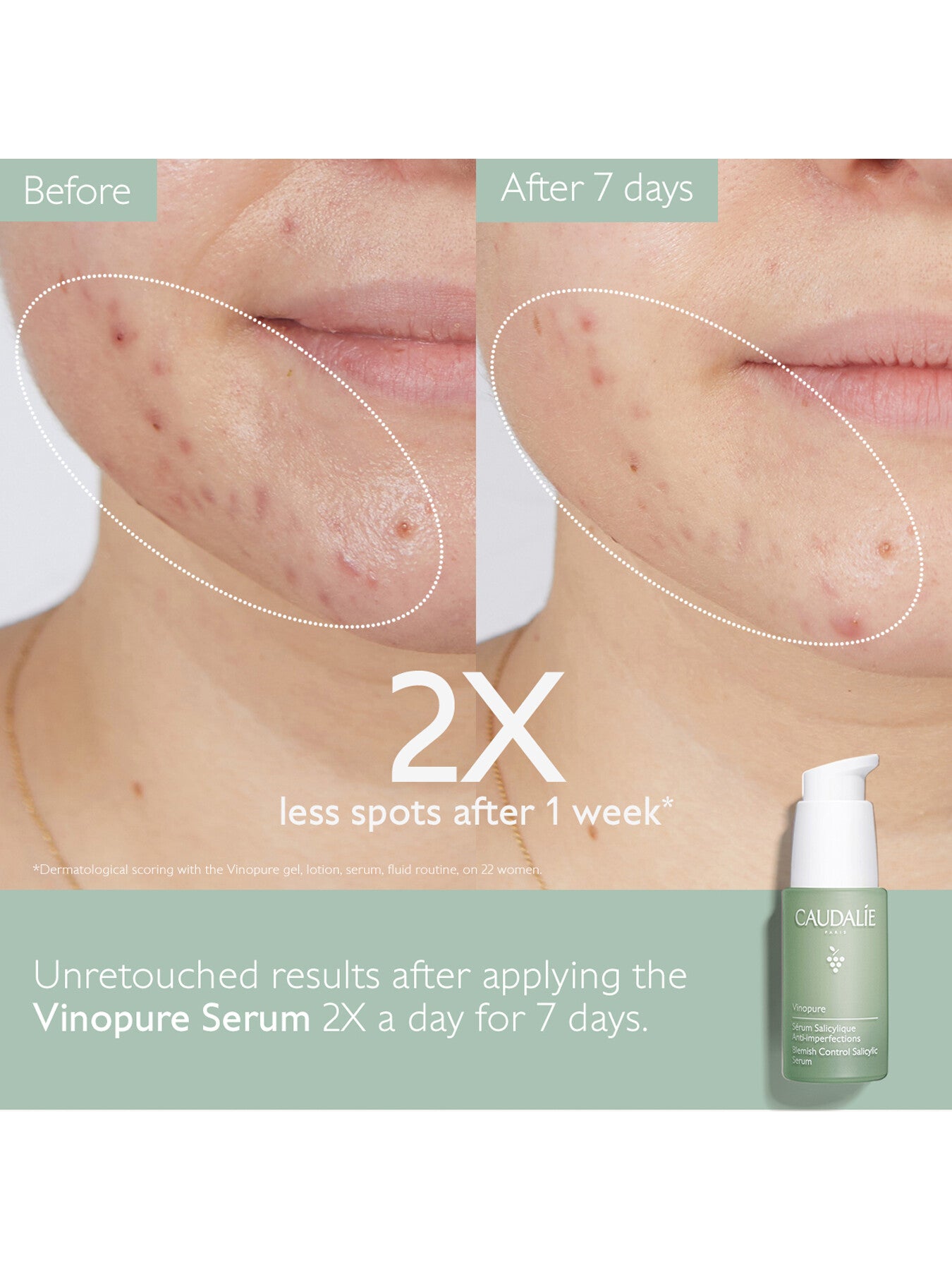 Vinopure Blemish Control Salicylic Serum 30ml