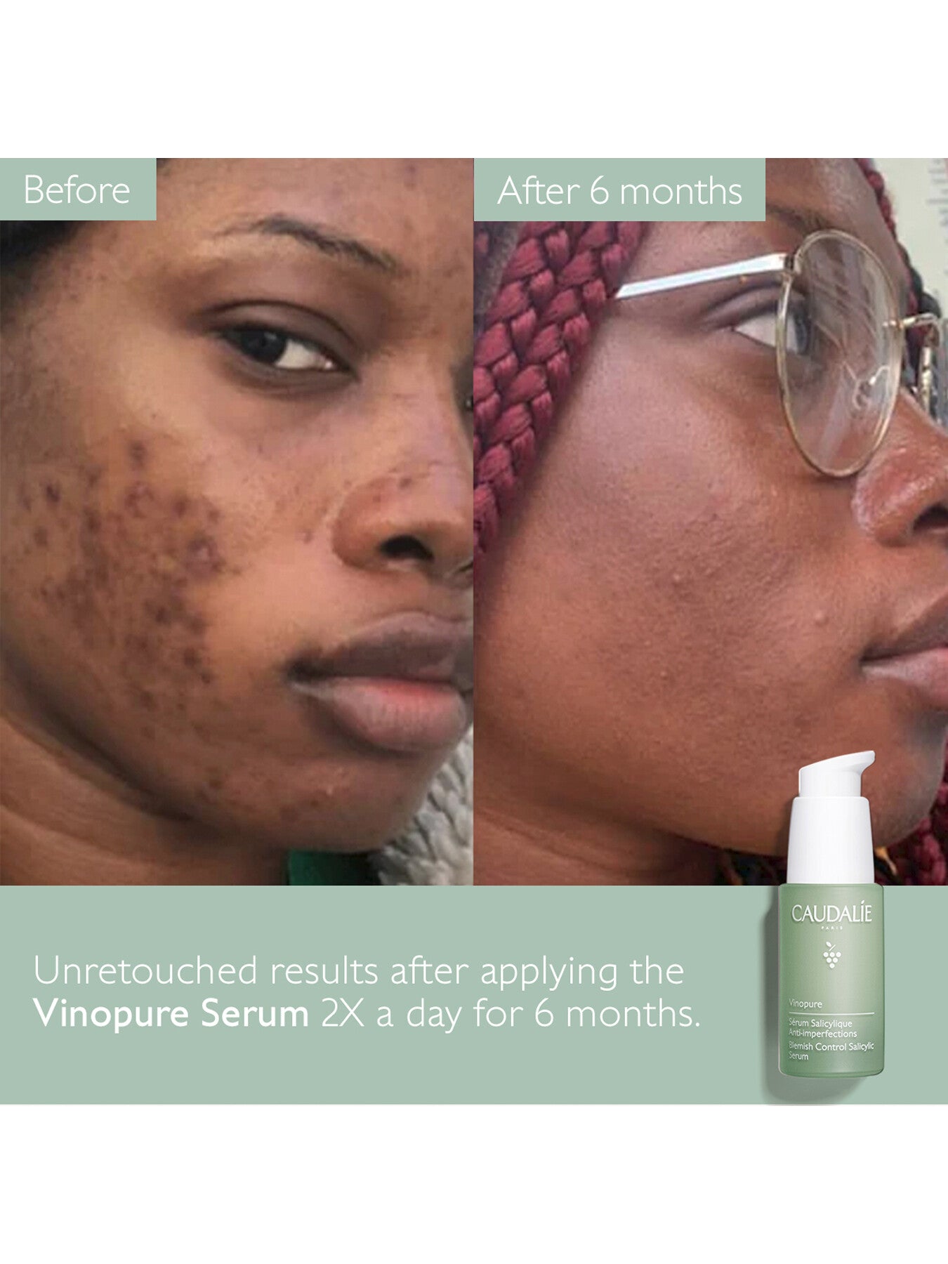 Vinopure Blemish Control Salicylic Serum 30ml