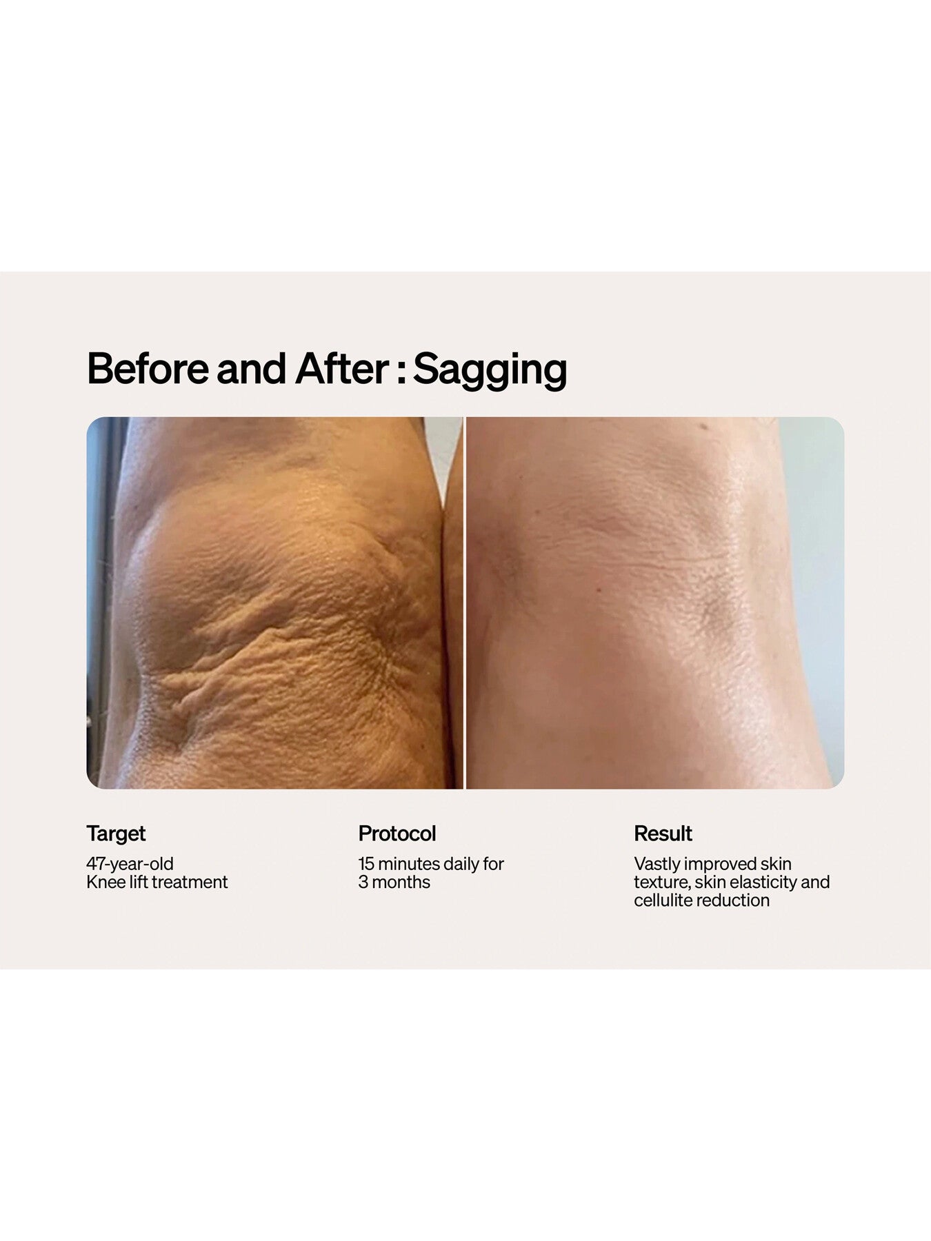 Lyma Laser Starter Kit