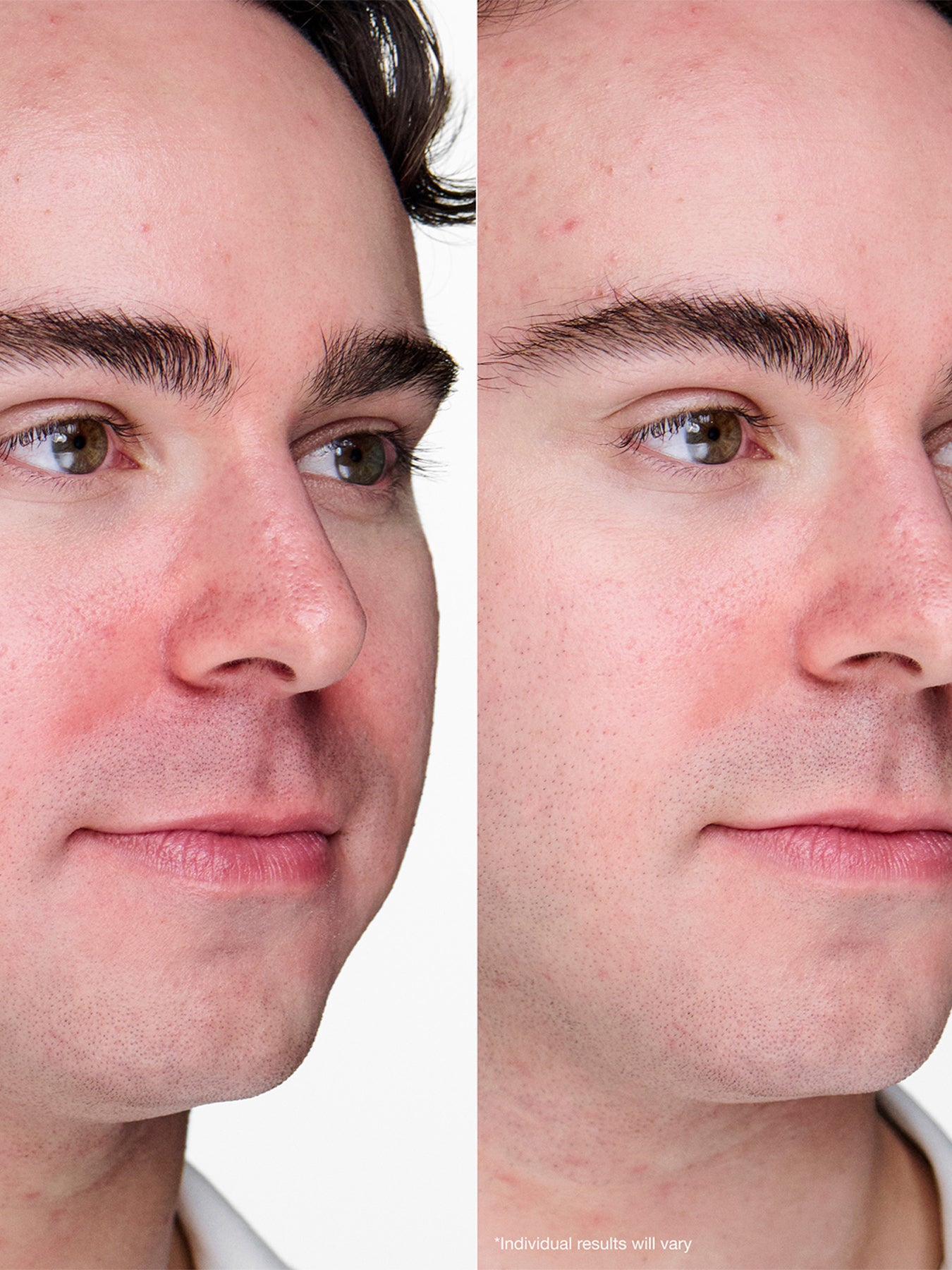 Anti Blemish Solutions Clinical Advanced Clearing Gel 20ml