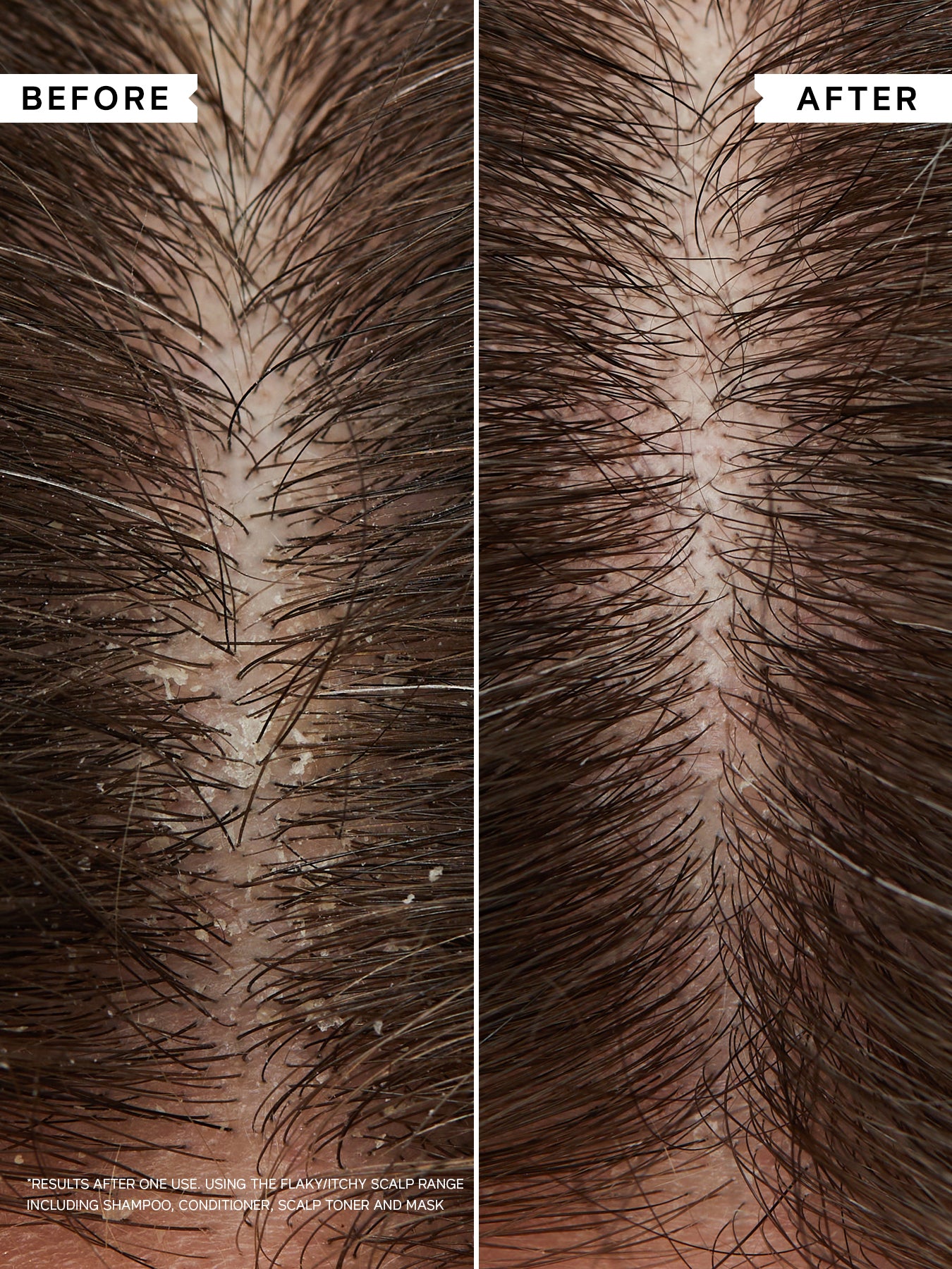 Flaky Itchy Scalp Anti-Dandruff Shampoo for Curly Hair 250ml