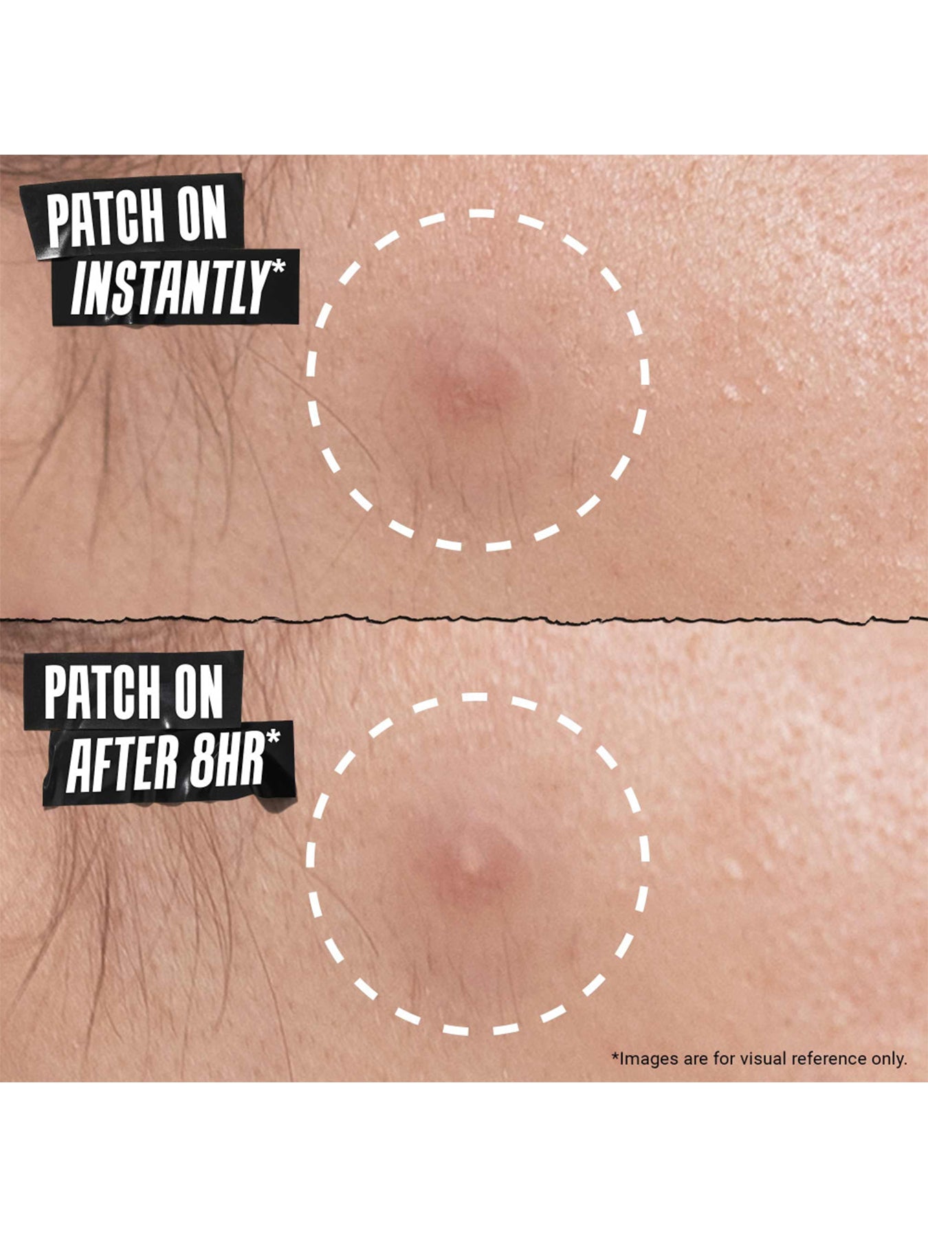Acne Physical Patch